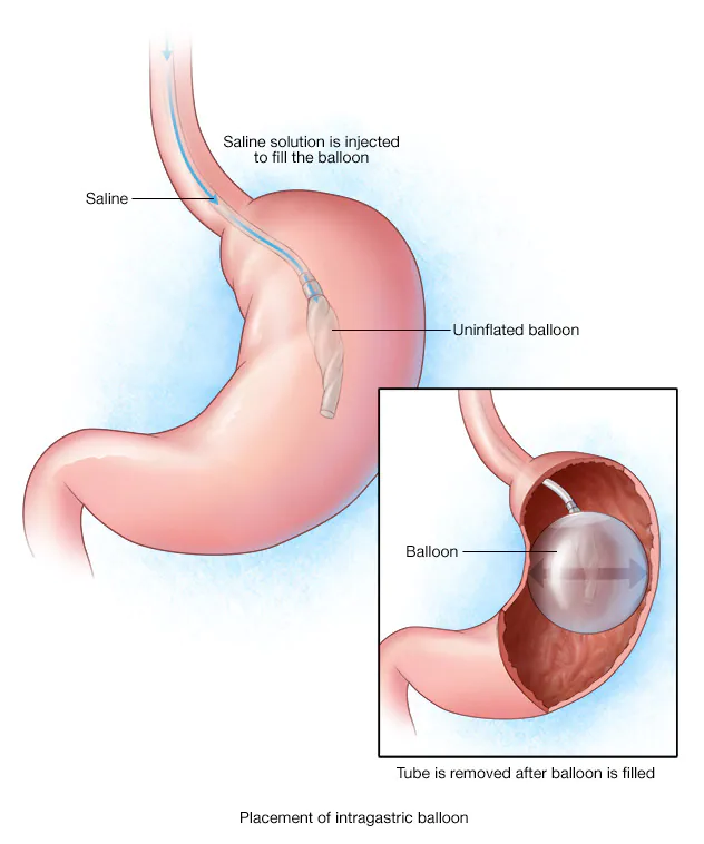 intragastric-balloon-8col